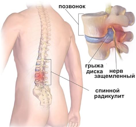 Массаж при радикулите поясничного отдела позвоночника