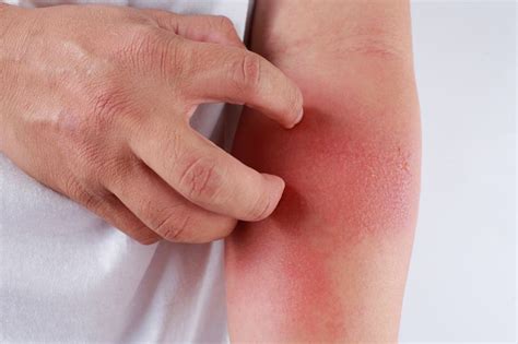 Symptoms and Causes of Polymorphic Light Eruption - Health & Detox ...