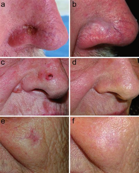 Treatment Of Superficial Basal Cell Carcinoma And Squamous Cell ...