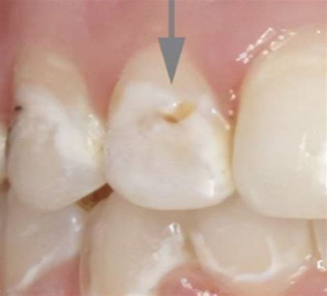 understanding dental cavities  prevention