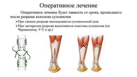 Шов сухожилия - презентация онлайн