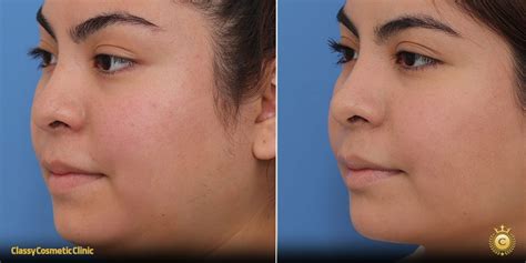 discover diverse face lifting treatment fjrl