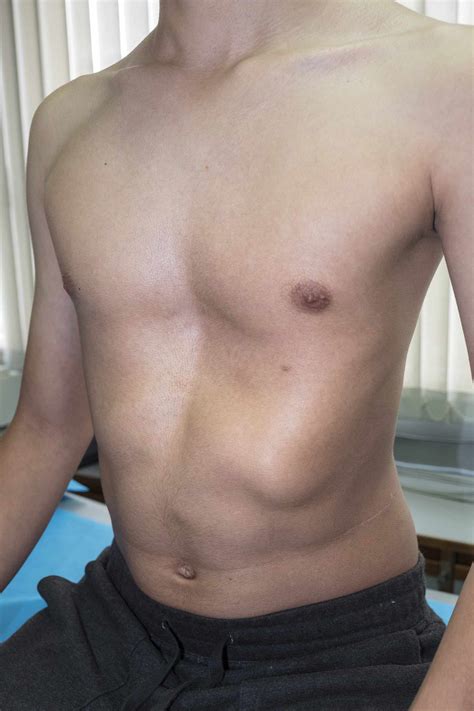 Pectus Excavatum Surgery: Preparation and Recovery