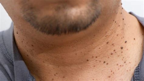 warts  face  neck