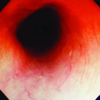 No esophageal varices were found under the ordinary endoscopy ...