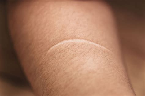 Scar Removal Treatment | Laser Scar Treatment | Dr. K & Associates
