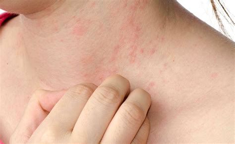 Sweat Rash Treatment and Prevention Tips