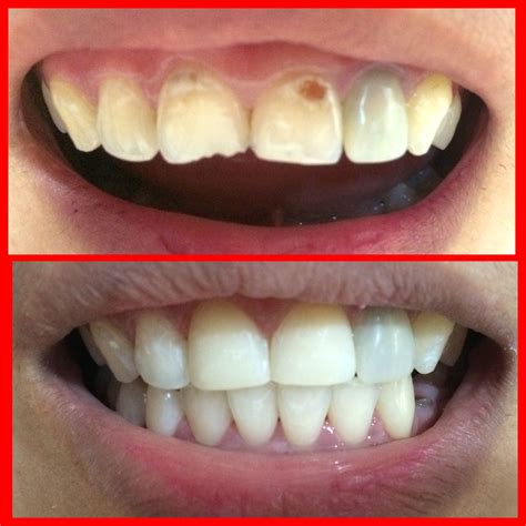 before and after tooth restoration (tooth # 11 & 12) | Dental, Dental