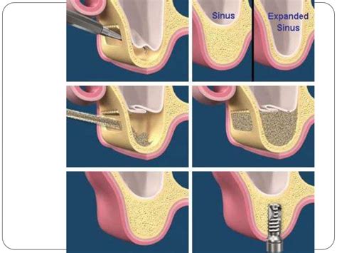 Maxillary Sinus lift surgery