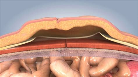 incisional hernia repair  mesh casia