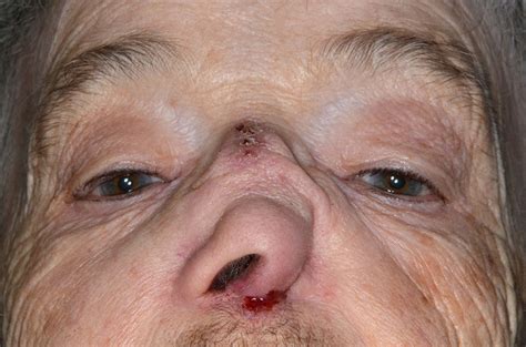 nose ulcer    debra moreland blog
