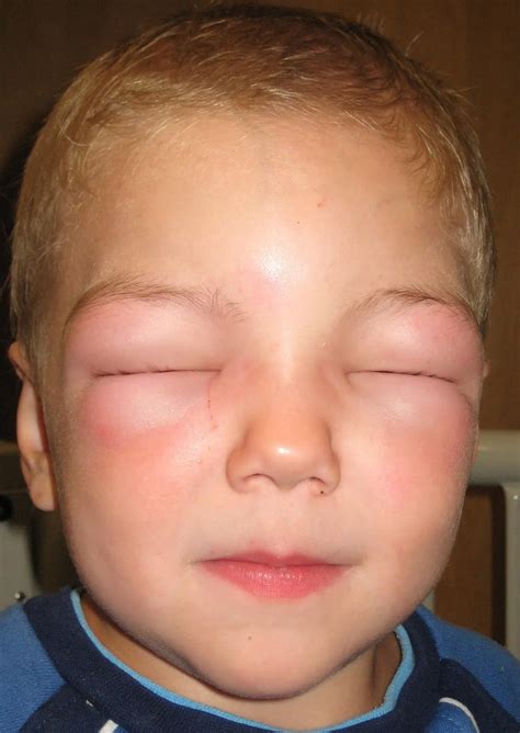 Allergic edema - causes and treatment. Types of allergic edema
