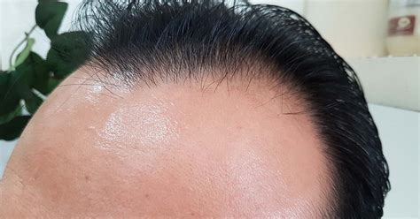 how to prevent hair loss due to sweating