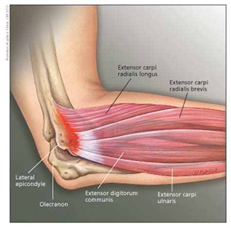 Lateral Epicondylitis - The Pain Source - Makes Learning About Pain ...