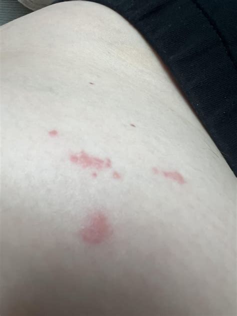 kind  bite rbugbites