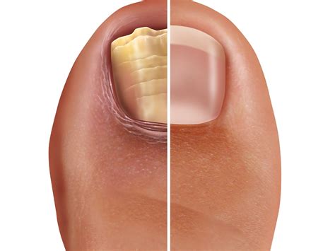 Fungal Toenails: Effective Treatment Options and Prevention Tips