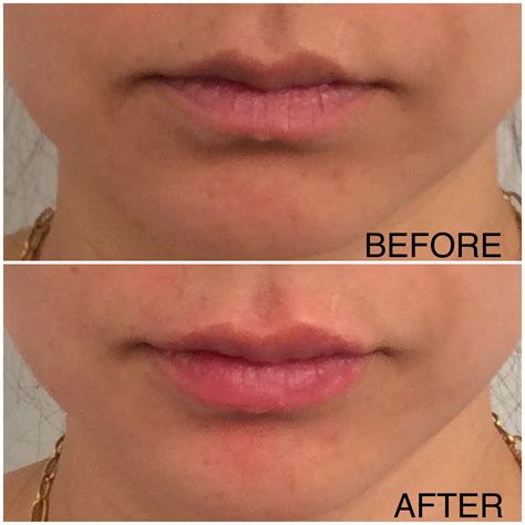 Why Are My Lips Blue | Lipstutorial.org