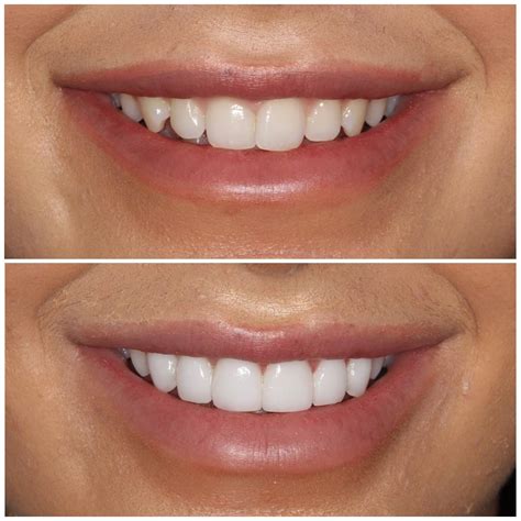 Teeth Veneers Before And After