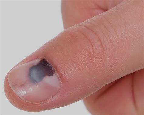 Mancha Escura Nos Dedos - Mancha de Sangue nas Unhas: O Que Pode Ser e Quando Procurar um ...