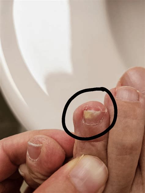 Toe nail fungus treatment : r/NailFungus