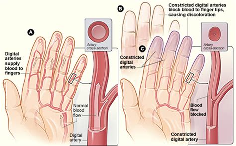 Raynaud's Disease - Causes, Symptoms, Treatment