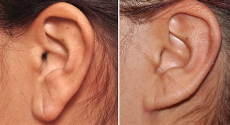 Ear Lobe Attached