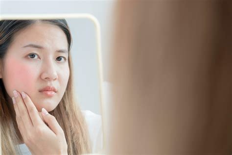 Woman worried about face Dermatology, rosacea dermatitis, allergic