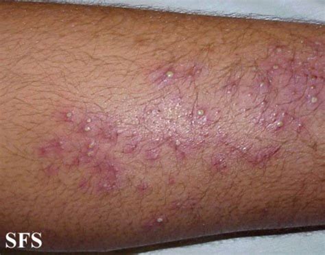 Fungal Skin Infections Rash at Dawn Moore blog