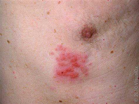 What to Expect With Shingles Rash: Early Stages and Progression - GoodRx