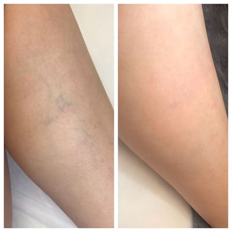 I Got a Laser Treatment for My Spider Veins and this is What Happened - Petals Laser Lounge