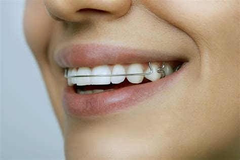 Beltway Orthodontics | Removable Metal Retainers in Atlanta