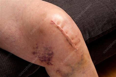 Partial Knee Replacement Scar