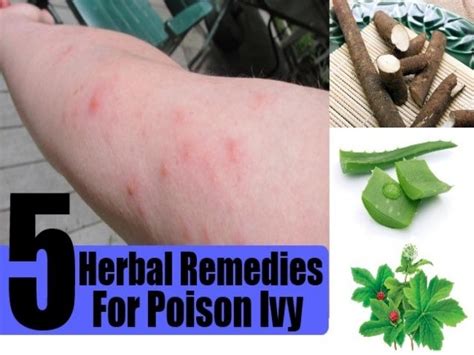 5 Herbal Remedies For Poison Ivy