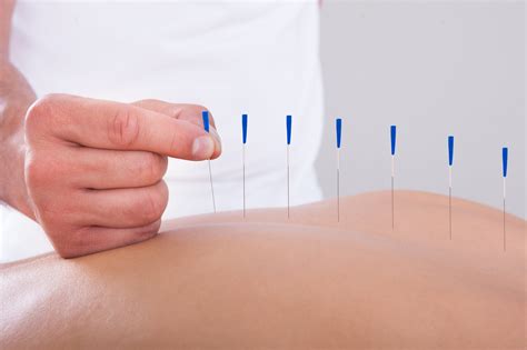 Top 5 Benefits of Acupuncture