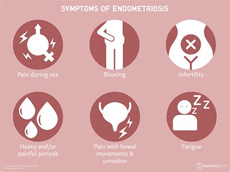 Endometriosis | Symptoms & Treatments & Support | AnatomyStuff