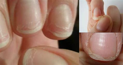 Unhas Fracas E Descamadas - Unhas fracas e descamando? Saiba porque... - Tudo de Salgados