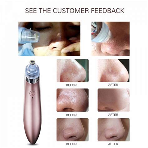 Professional Electric Blackhead Vacuum - up to 80% OFF. Buy from ...