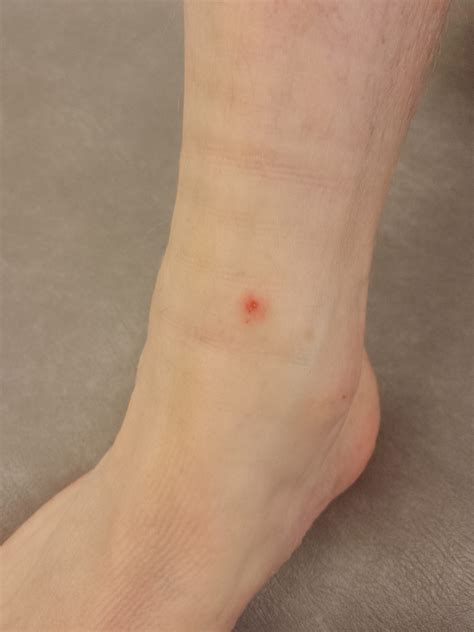 Mosquito Bites - Podiatry & Gait Clinic