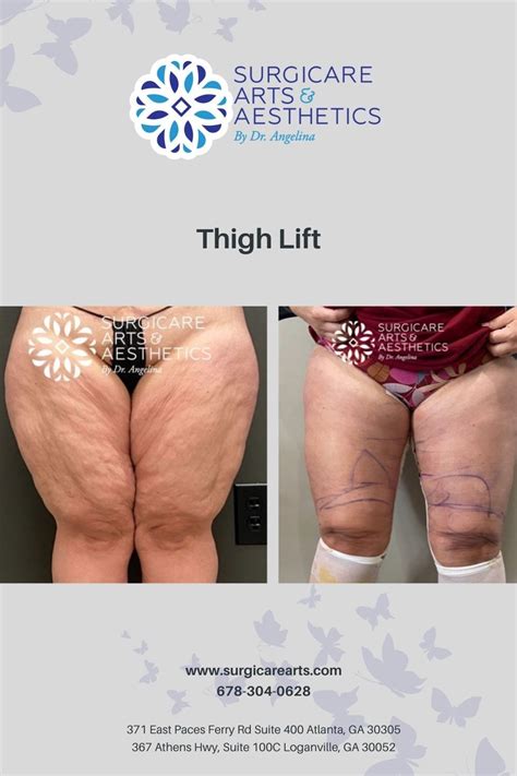 Thigh Lift Before & After | Tummy tucks recovery, Body surgery ...