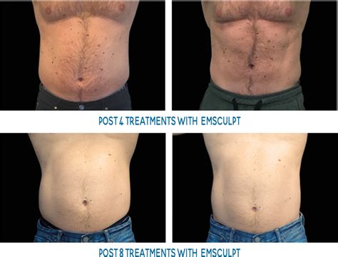 Male abs before and after emsculpt | InnerImage