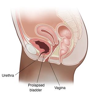 Pelvic Organ Prolapse: Surgery for Cystocele | Saint Luke's Health System