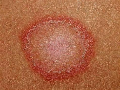 Ringworm in babies causes, signs, symptoms, diagnosis & treatment