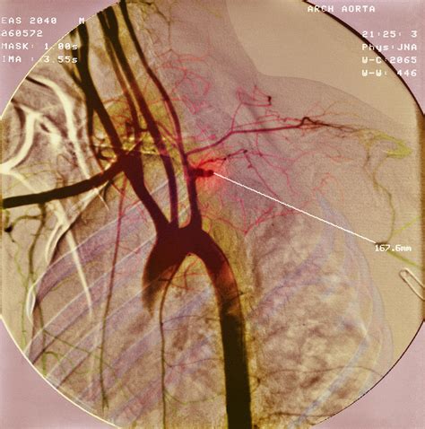 blocked artery photograph  simon fraserscience photo library pixels