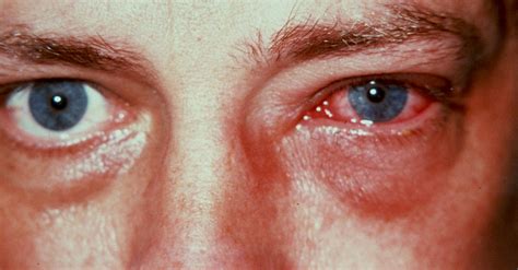 Colirio Para Conjuntivite Crianca