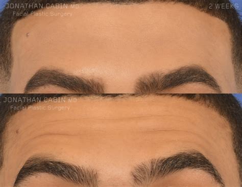 Forehead Botox - Dr. Jonathan Cabin
