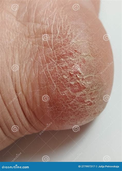 Onychomycosis and Dry Skin on the Heel of the Female Leg. Candida