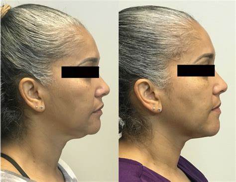 liposuction fat grafting richmond ent