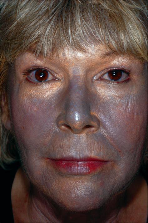 Argyria