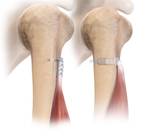 arthrex fibertak button tenodesis technique