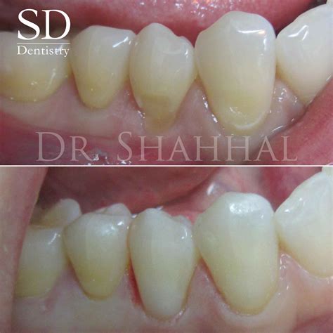Abfraction Teeth